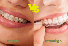 Invisalign vs Braces: Which Option Is Better for Your Smile?