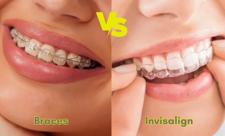 Invisalign vs Braces: Which Option Is Better for Your Smile?