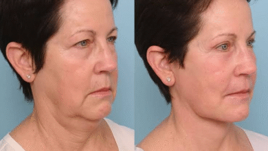 Deep Plane Facelift Surgery UK